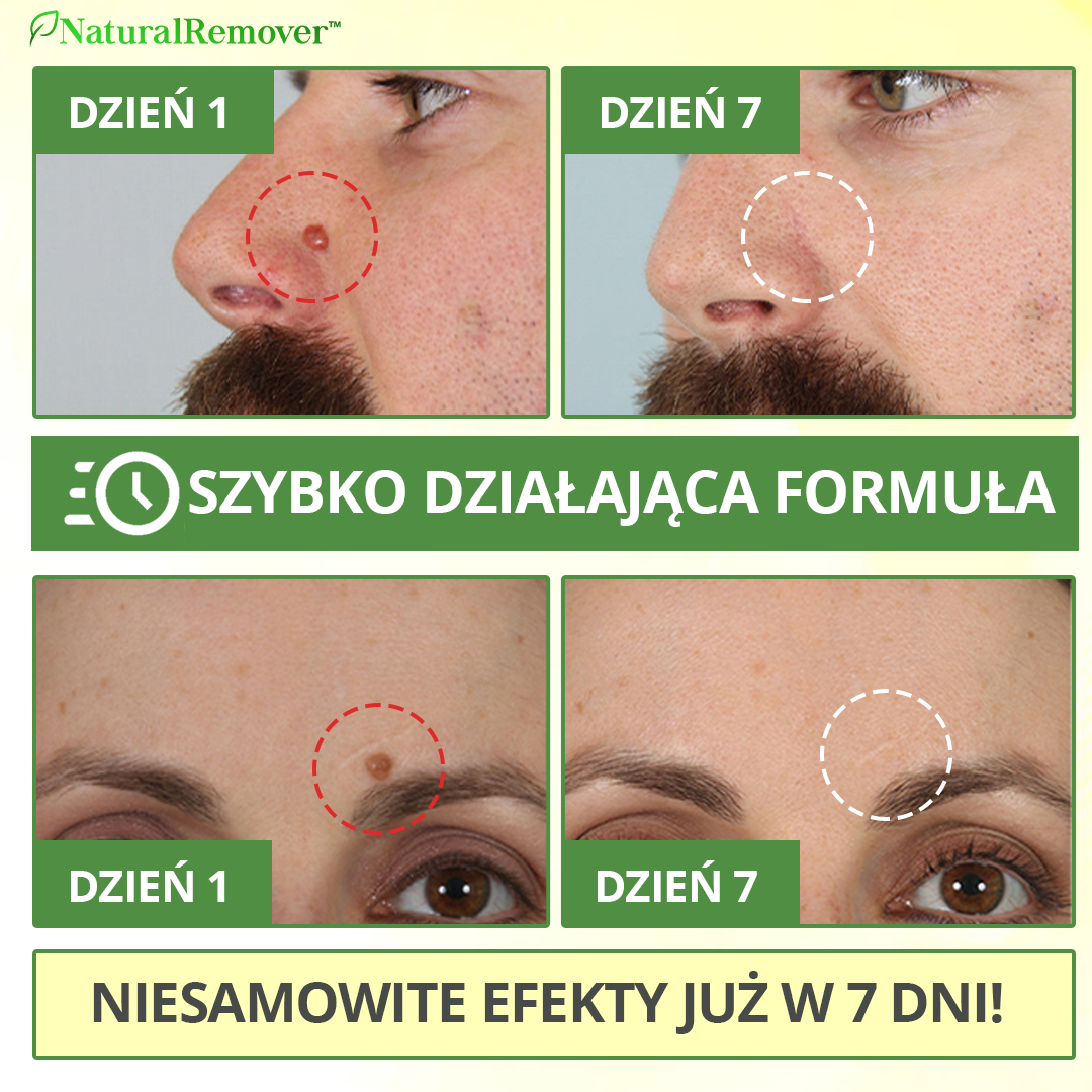 NaturalRemover™ Środek do Usuwania Znamion Skórnych