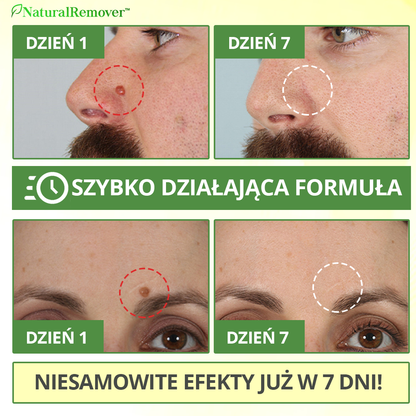 NaturalRemover™ Środek do Usuwania Znamion Skórnych