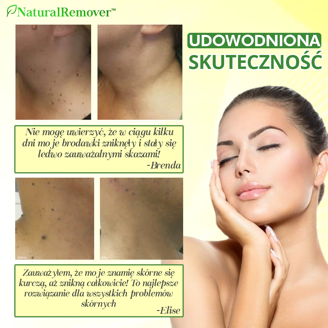 NaturalRemover™ Środek do Usuwania Znamion Skórnych